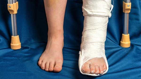 MUST READ : Avoid these mistakes after getting a fracture for speedy recovery