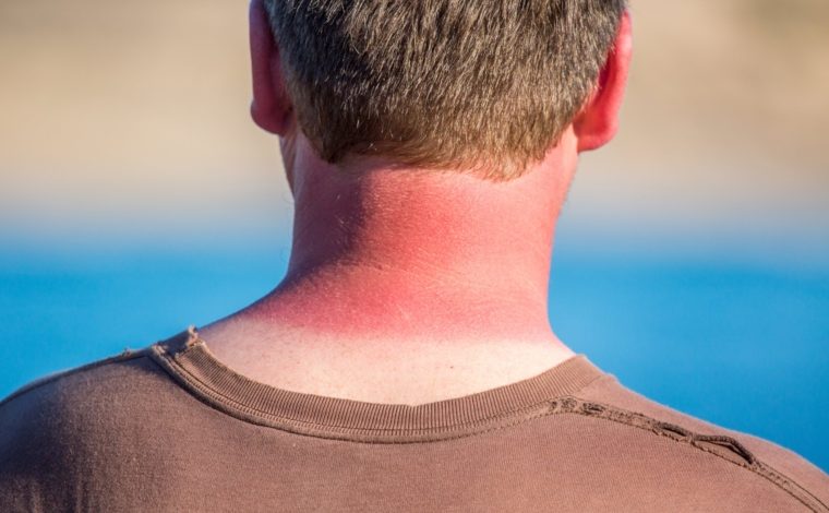 महिलाओं की तुलना में पुरुषों को त्वचा कैंसर अधिक होता है , पुरुषों त्वचा की सुरक्षा के लिए सनस्क्रीन पहनने से इनकार करते हैं